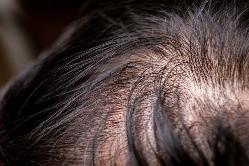 переваги трансплантації волосся