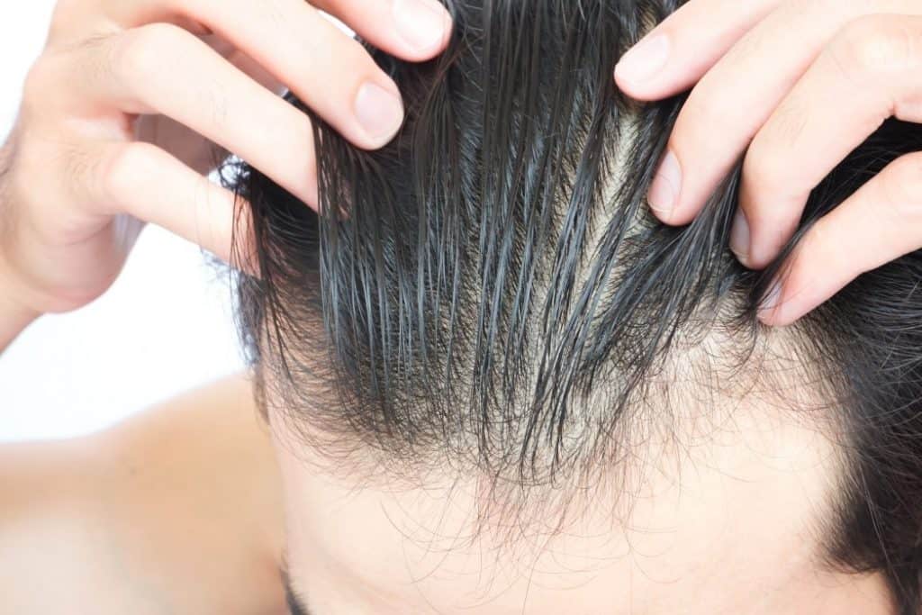 причини випадіння волосся у чоловіків